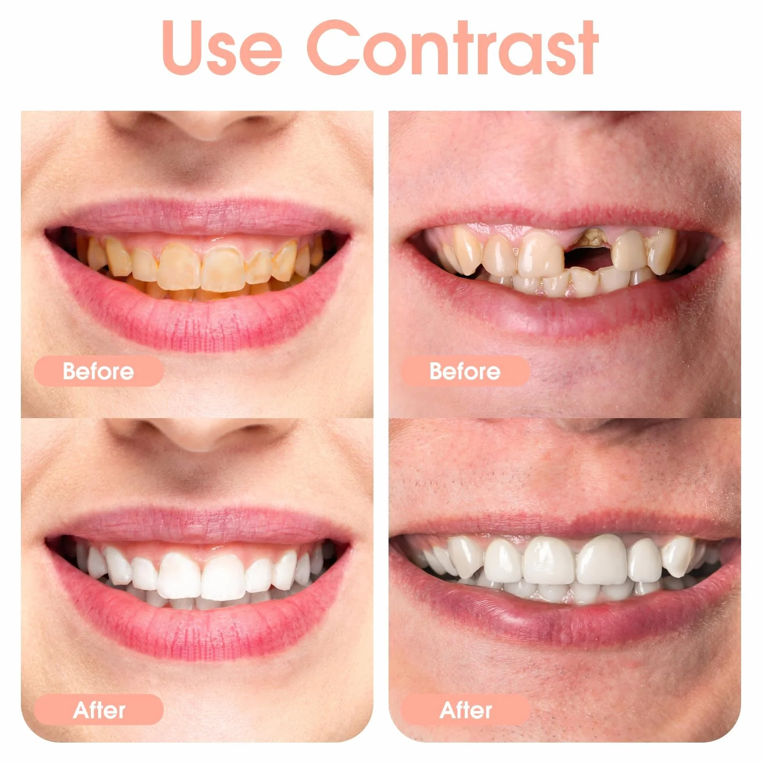 Snap on Perfect Smile Sztuczne Zęby 1 Pary Zatrzaskowe Silikonowe Forniry, Tymczasowe Wybielanie Proteza Okładka Górne I Dolne, Licówki Natychmiastowe Protezy Dla Mężczyzn I Kobiet Dorosły